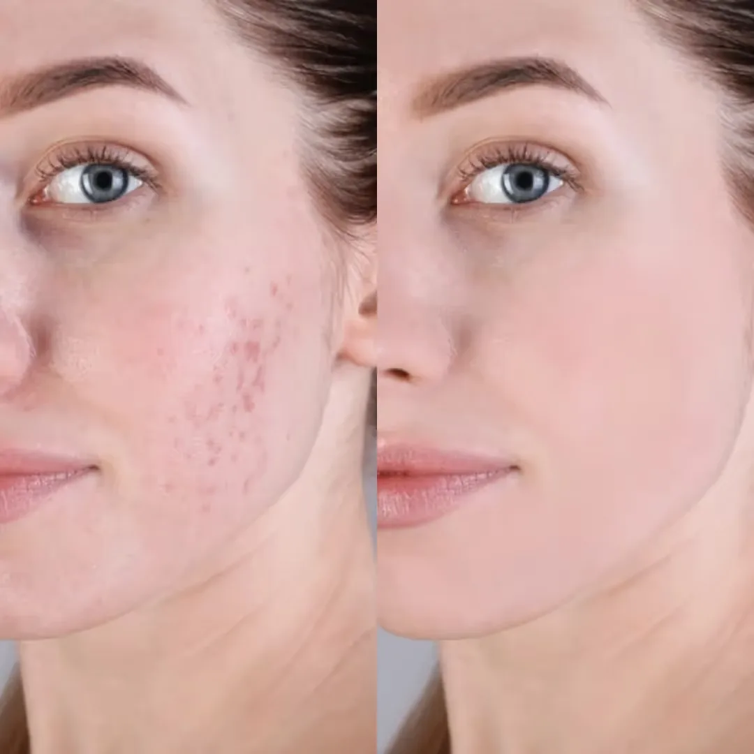 Acne and scars solutions
