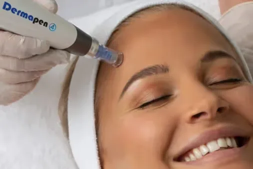 Advanced Microneedling performed by the dermatologist
