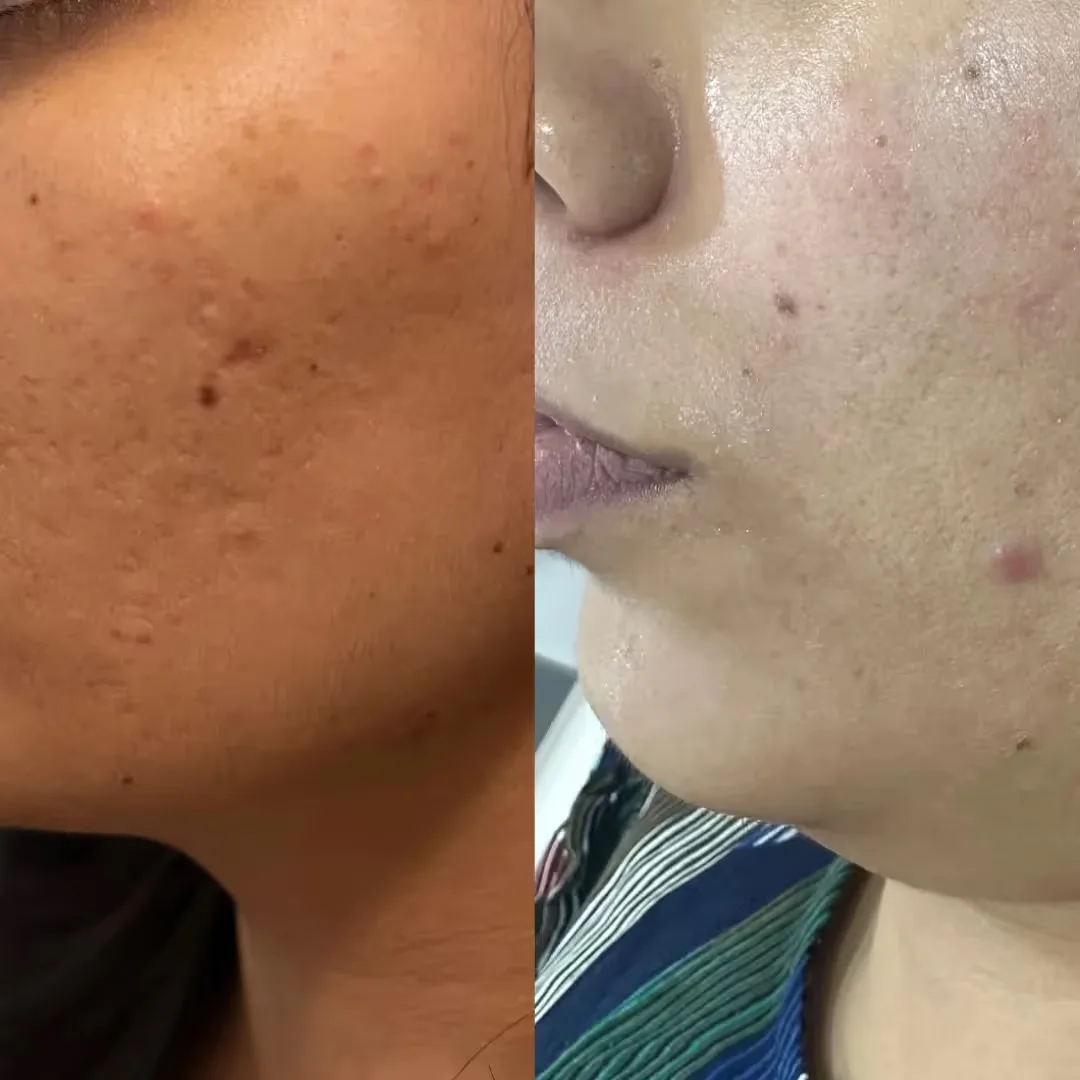Cost of Advanced Microneedling at UNCOVER Clinic
