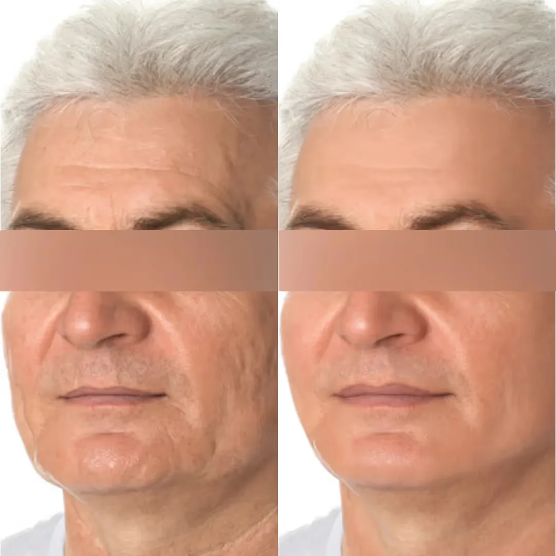 Before and after Anti-Aging Peel treatment