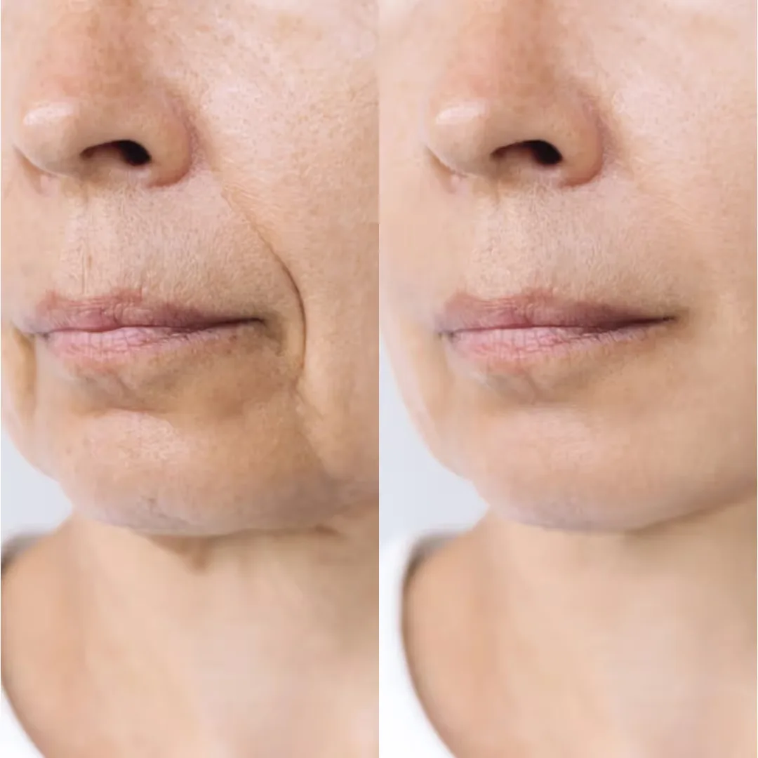 Before and after Anti-Aging Peel performs at Uncover