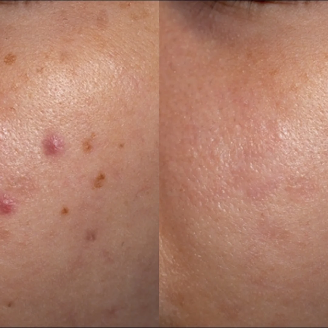 Before and after Anti-Scar Peel treatment at Uncover