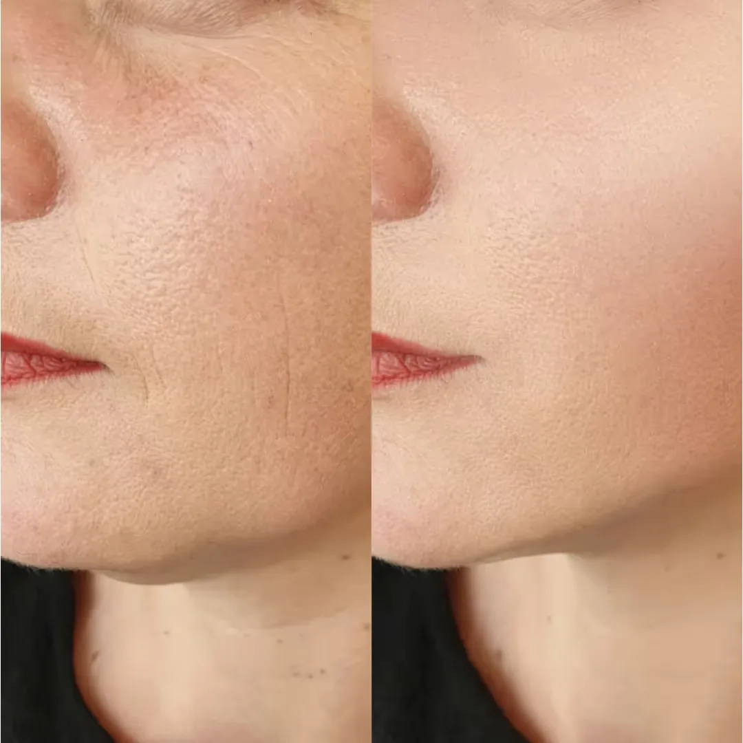 Cost of Black Peel at UNCOVER Laser, Skin and Hair Clinic