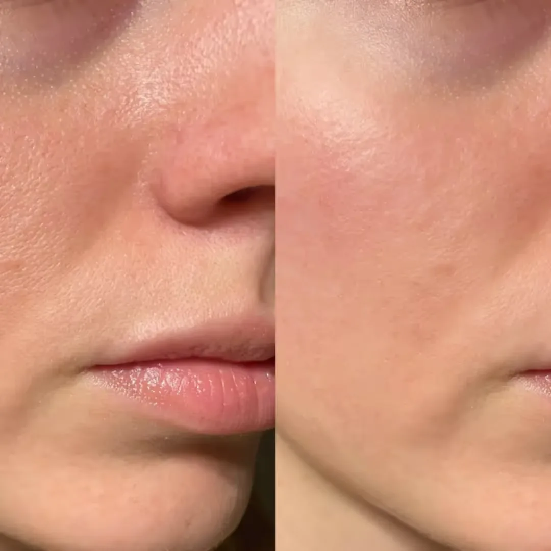 Before and After Skin Tightening Treatment at Uncover