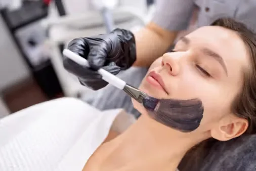 Carbon Facial peel applied by an expert dermatologist
