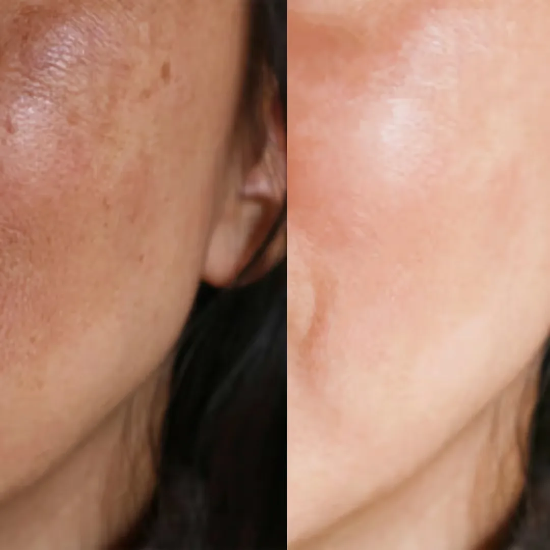 After and before the results of Carbon Facial