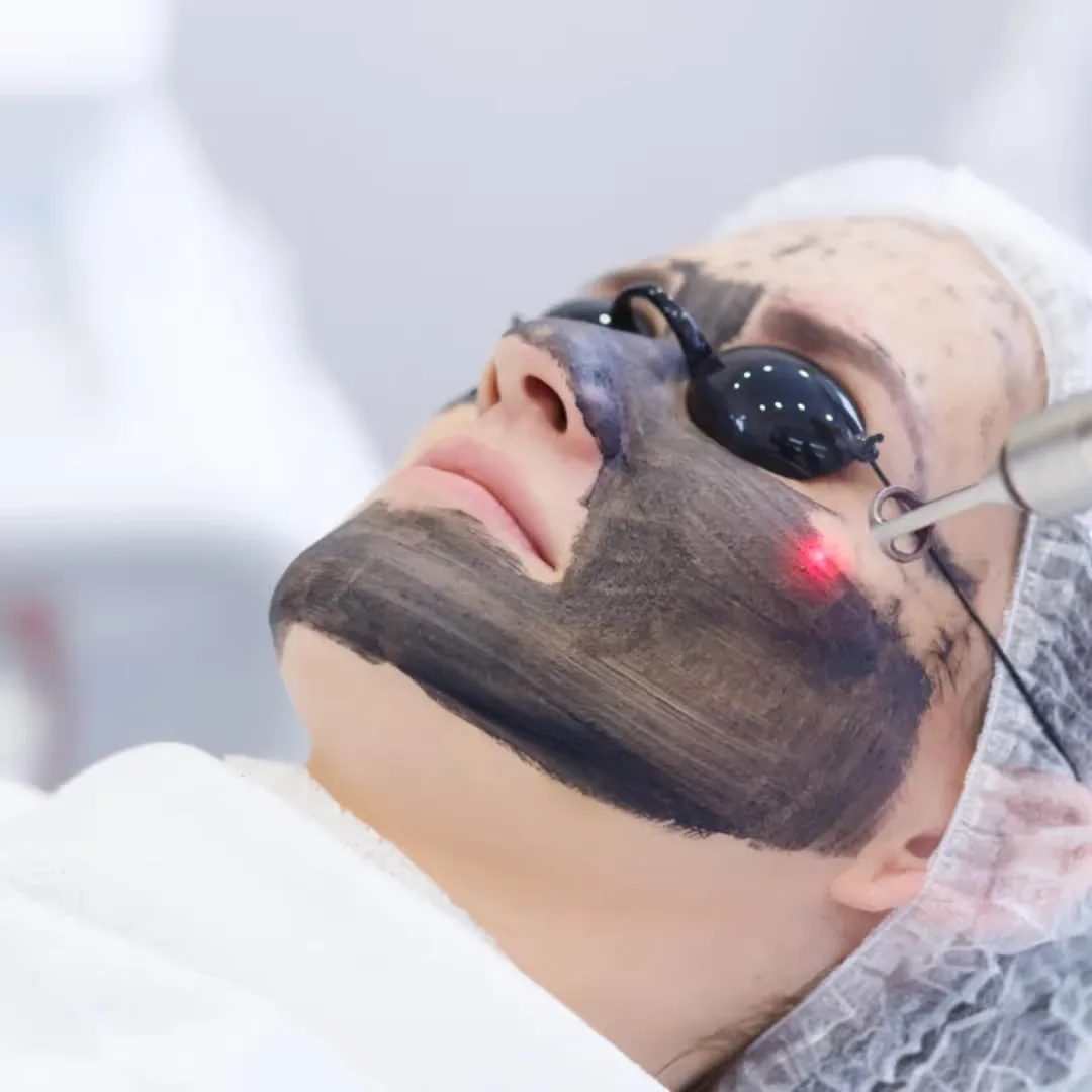 Laser Carbon Facial treatment by dermatologists
