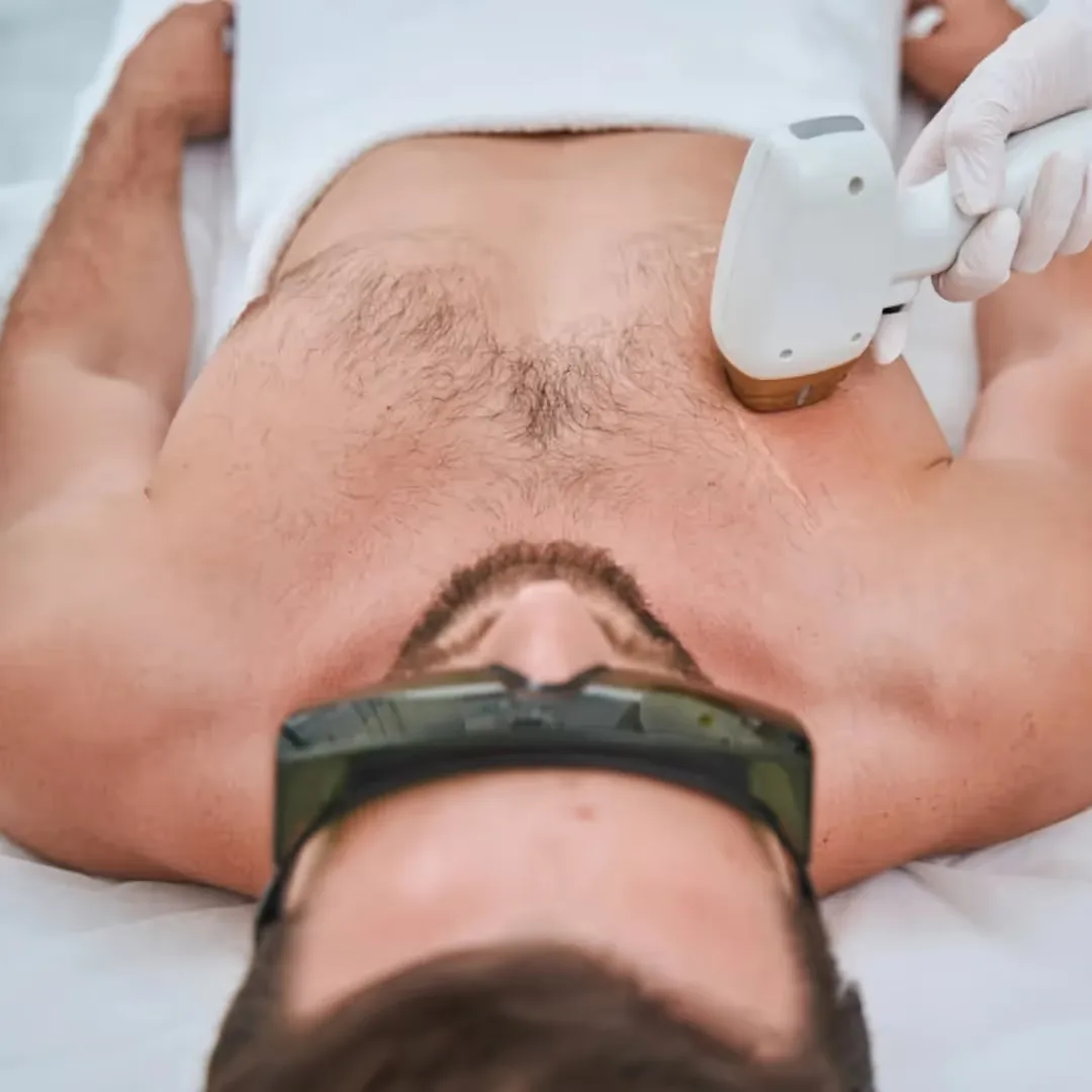 A dermatologist performs chest laser hair removal in Gurgaon & Delhi NCR 