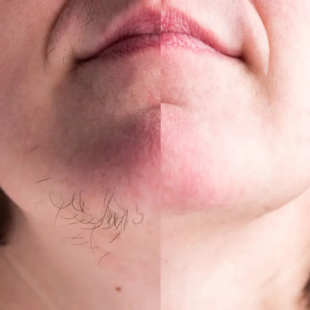 Before and after laser hair removal treatment for chin