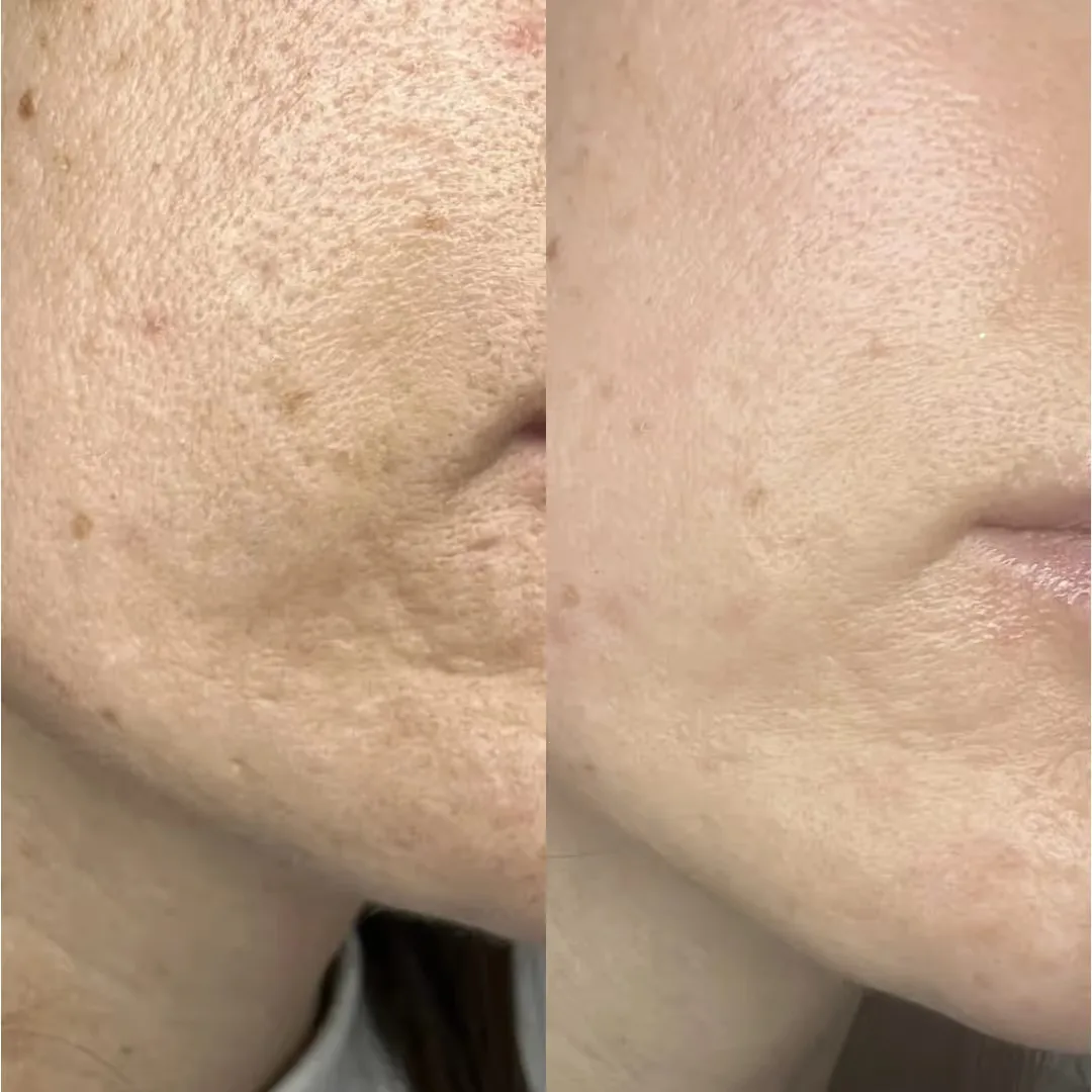 CO2 Laser Treatment before and after image