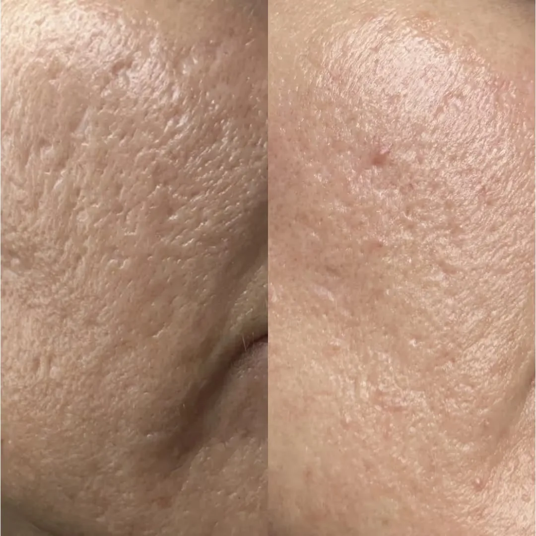 Why Choose Uncover Clinic for CO2 Laser Treatment?