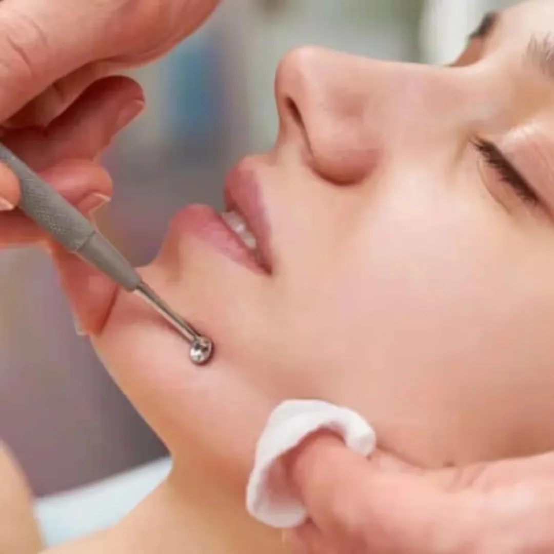 A dermatologist performs Comedon Extraction treatment