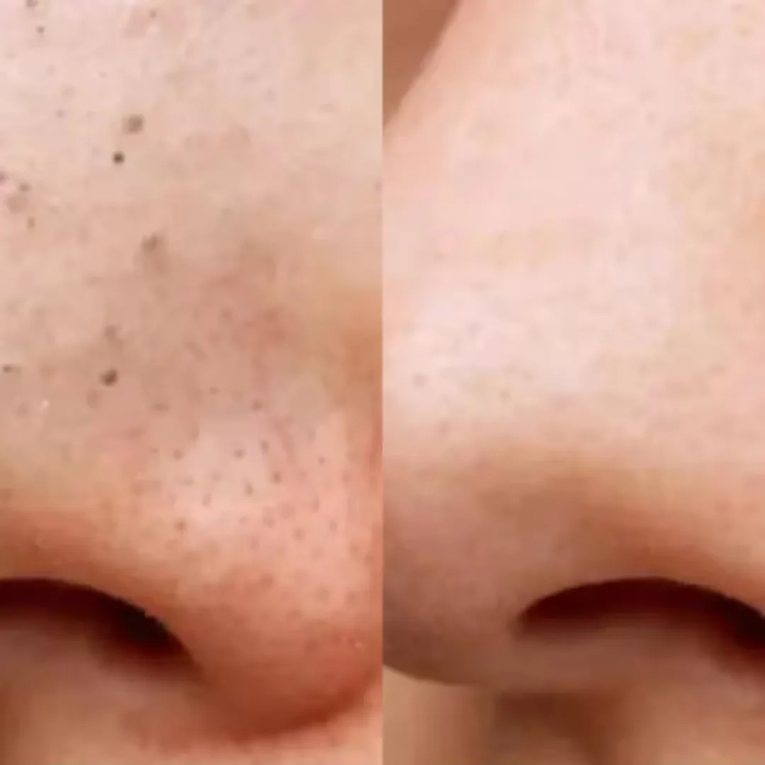 Before and after Comedon Extraction Treatment Image