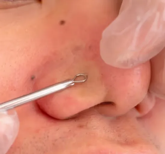 Comedon Extraction treatment is performed at Uncover