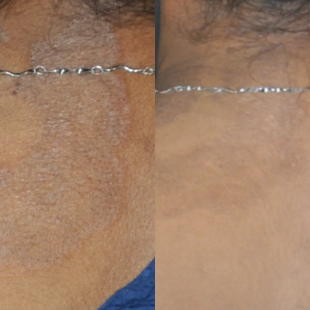 Before and after derma treatment images