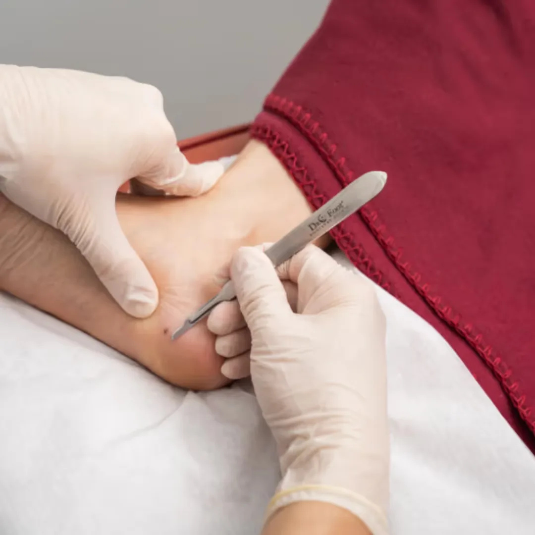 A dermatologist performs Corn Removal treatment