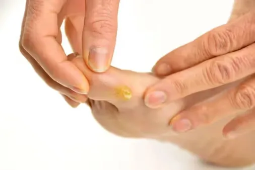 Person with suffering from Corn