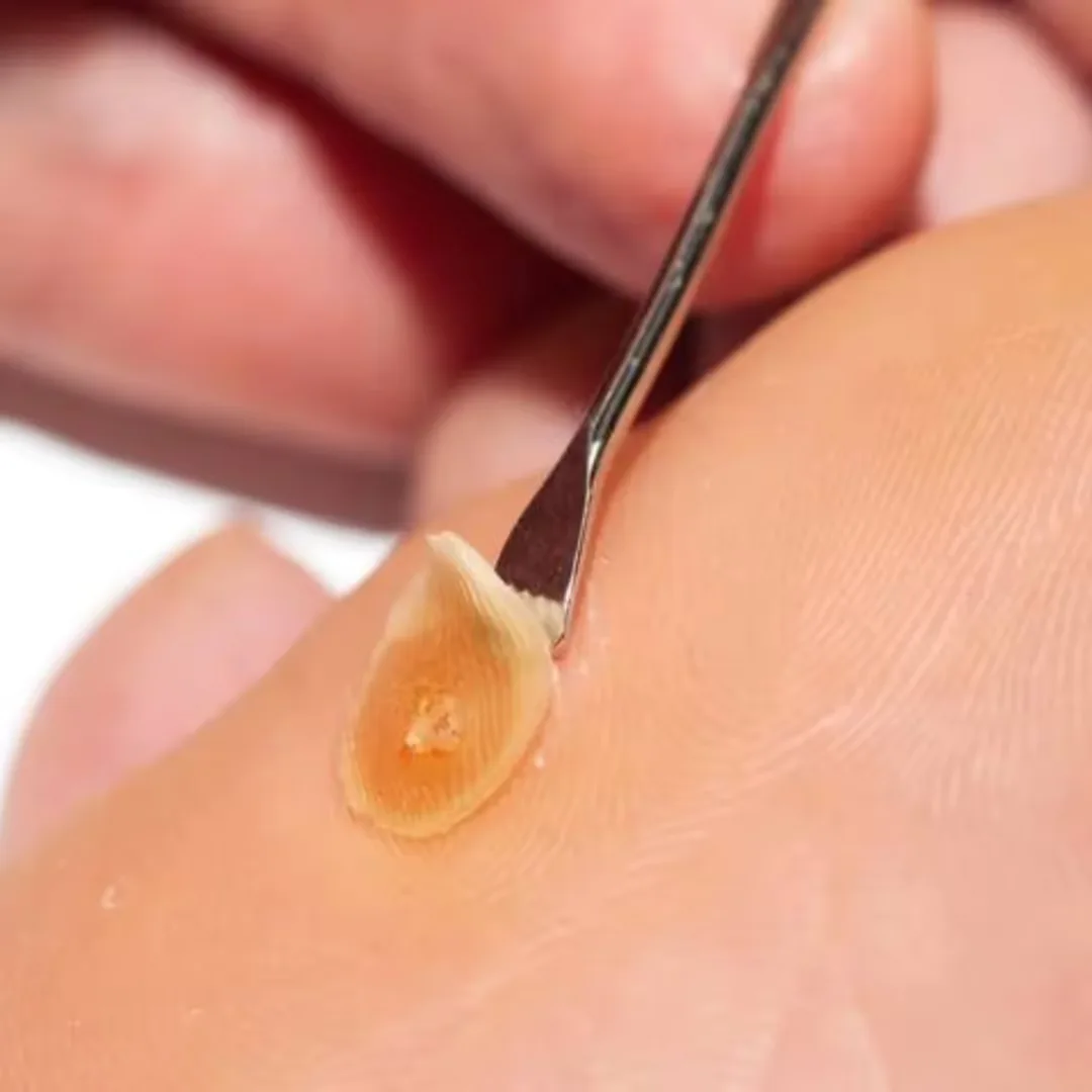 Corn Removal treatment is performed at the Uncover