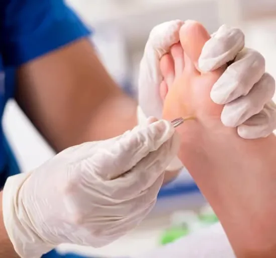 Corn removal Treatment performs at Uncover Clinics