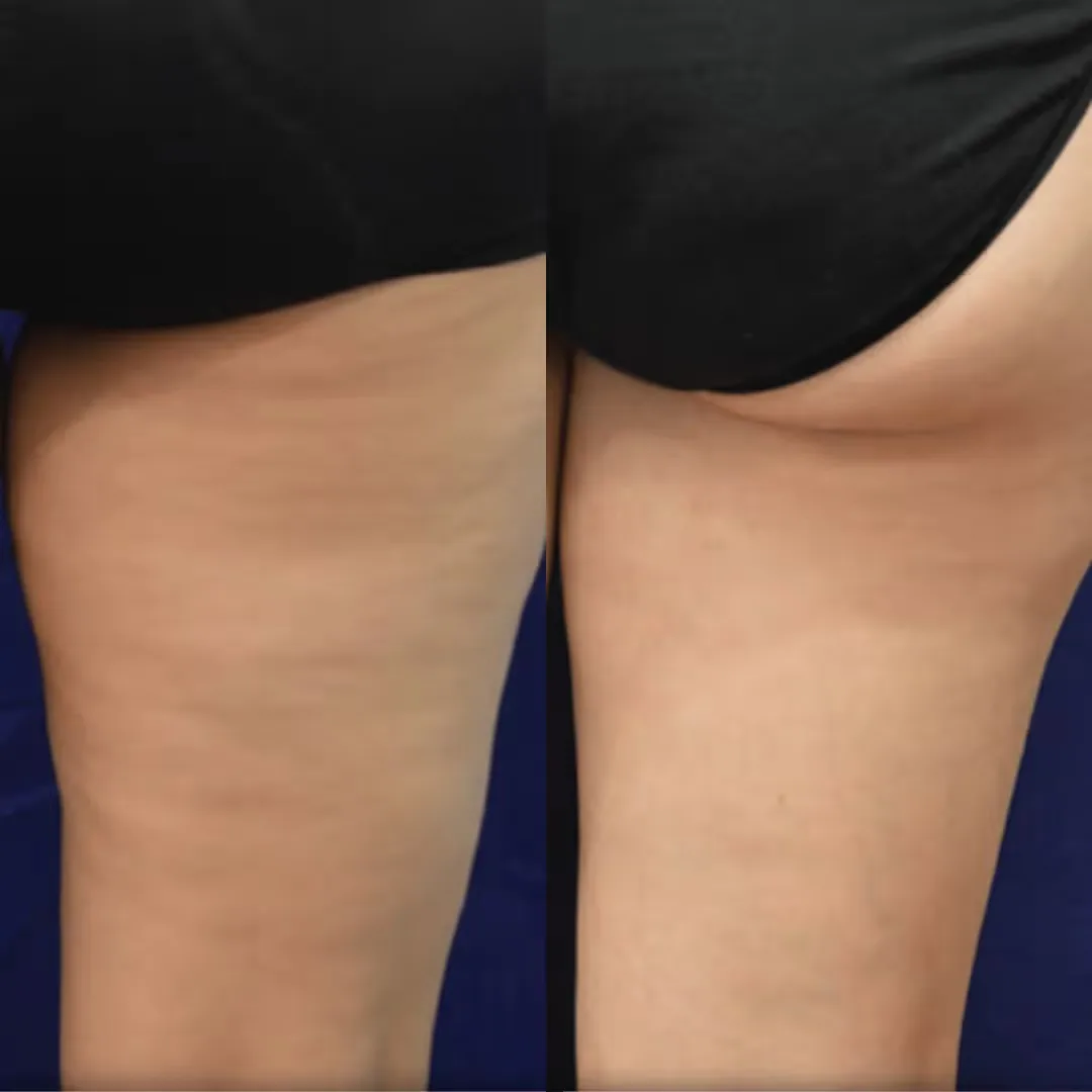 Before and after Body Contouring treatment result