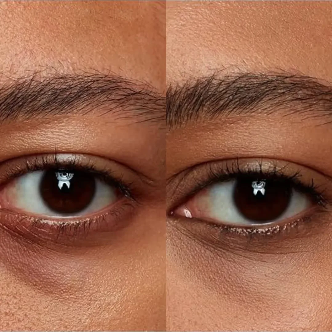 Side Effects of Hydrafacial Elite MD