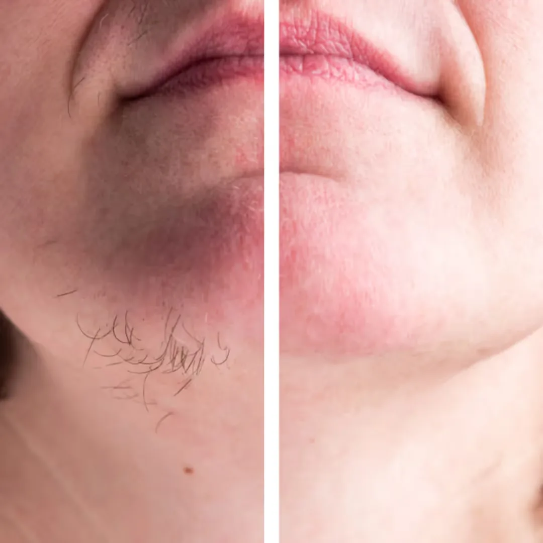 Face Laser Hair Removal results before and after image