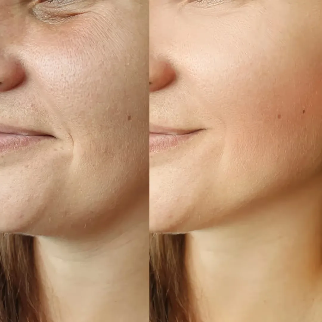 Before and after Filler treatment results