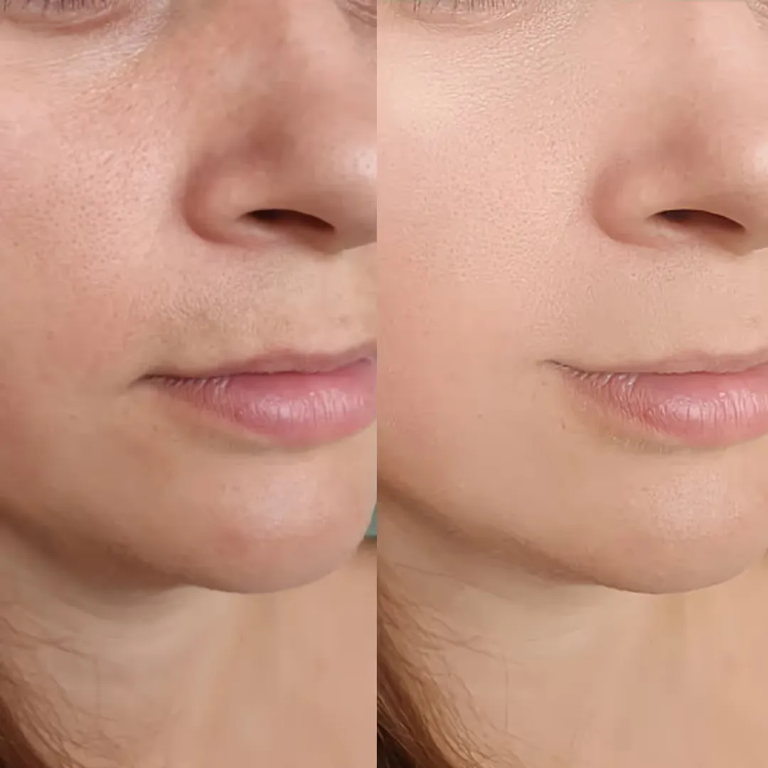 Before and after the Fire and Ice Facial at UNCOVER Clinics