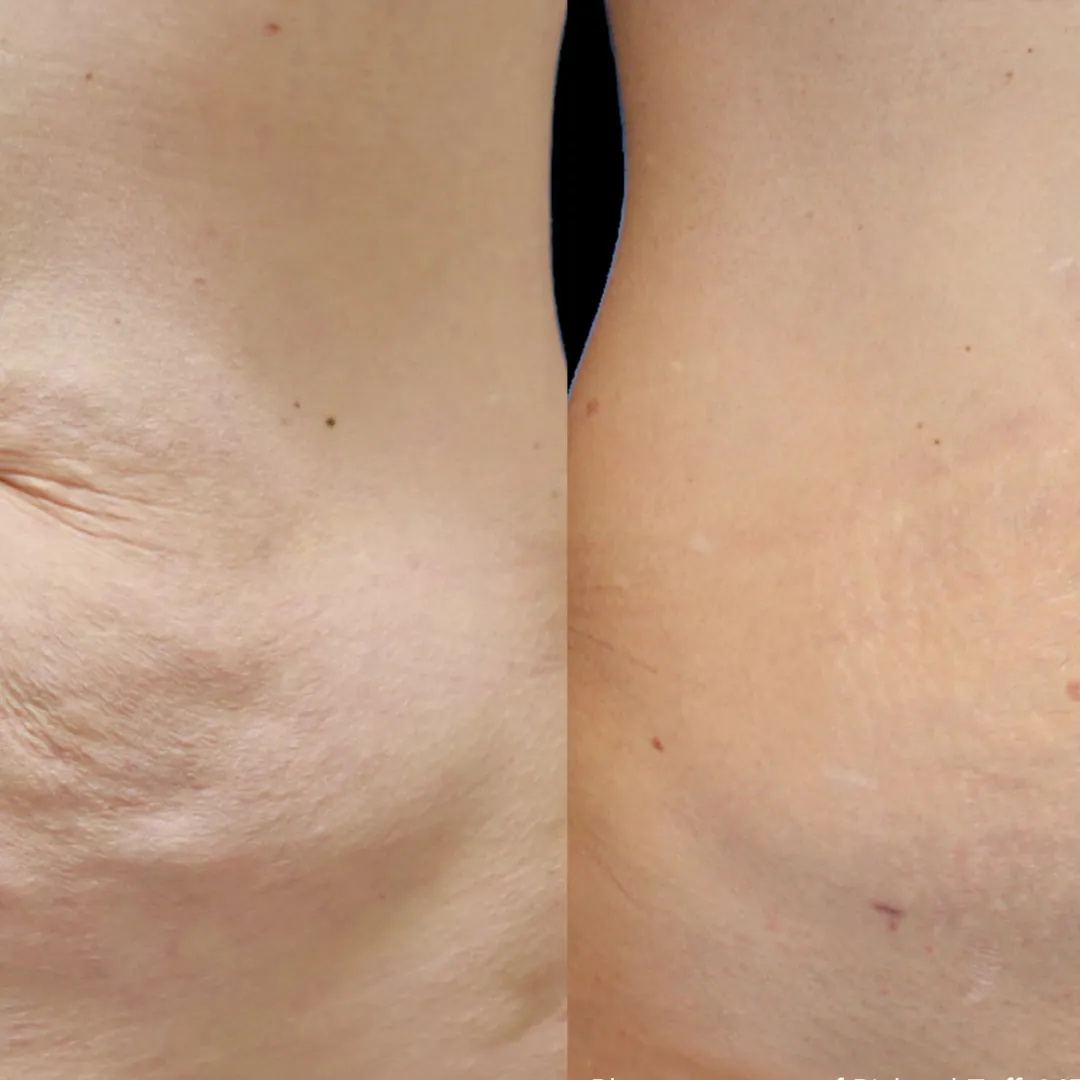 Before and after Contouring with Forma RF Treatment