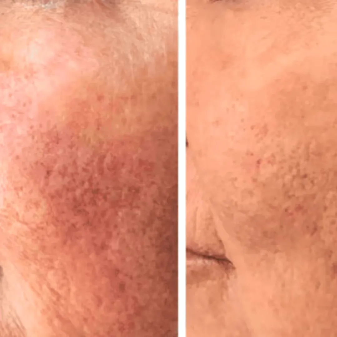 Before and after GFC treatment images