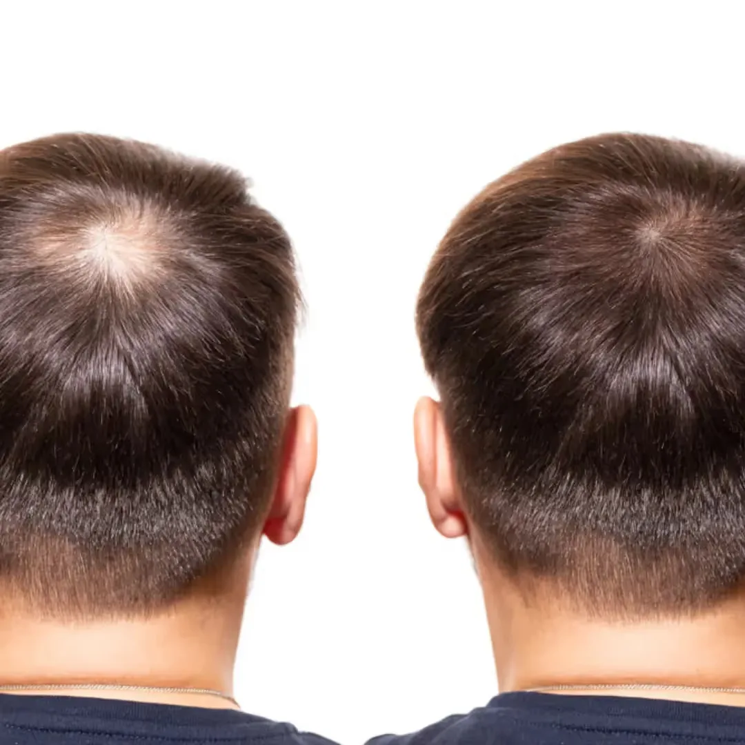 Plasma Hair Restoration Treatments at UNCOVER Clinics