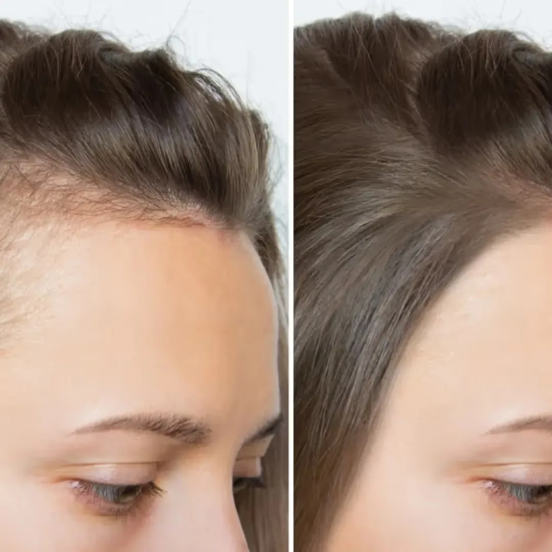 Before and after results image of Plasma Hair Restoration (GFC) therapy