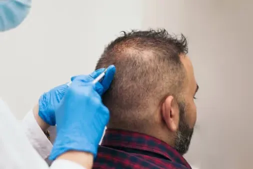 GFC with Mesotherapy performed at Uncover