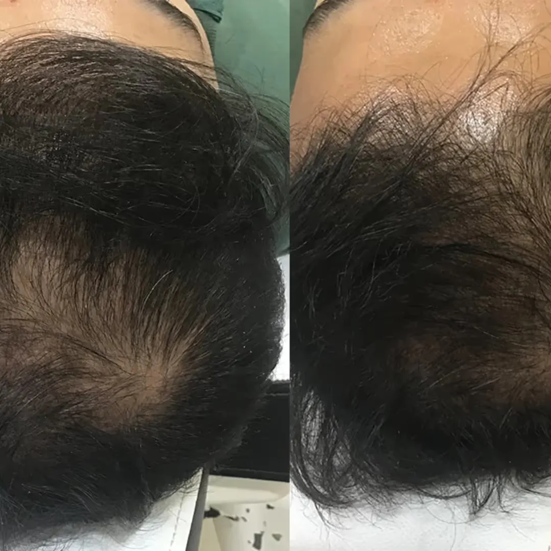 Before and after GFC Mesotherapy images