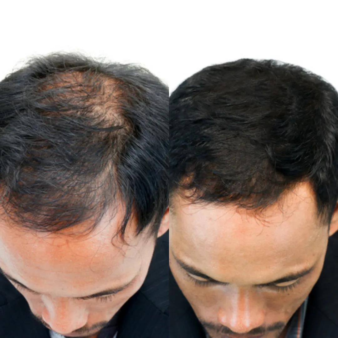 Before and after GFC with Microneedling treatment images