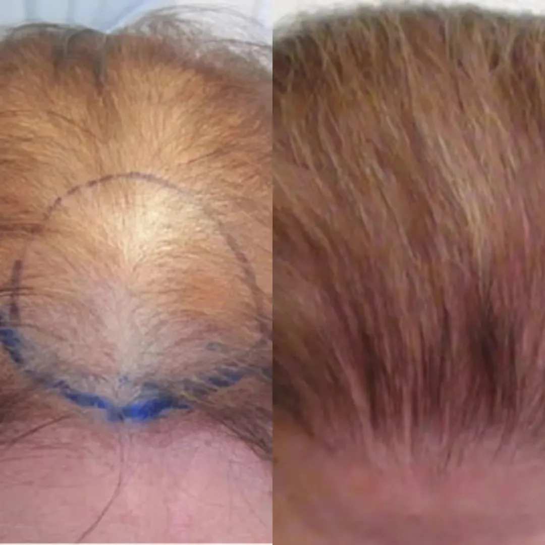 Before and after hair transplant therapy image