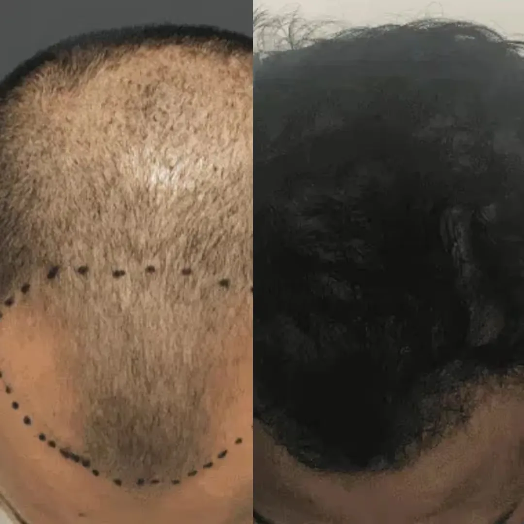 Hair transplant performed by the Advanced FUE Technology results