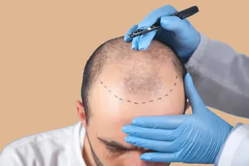 Marking concern areas on the head by the dermatologist