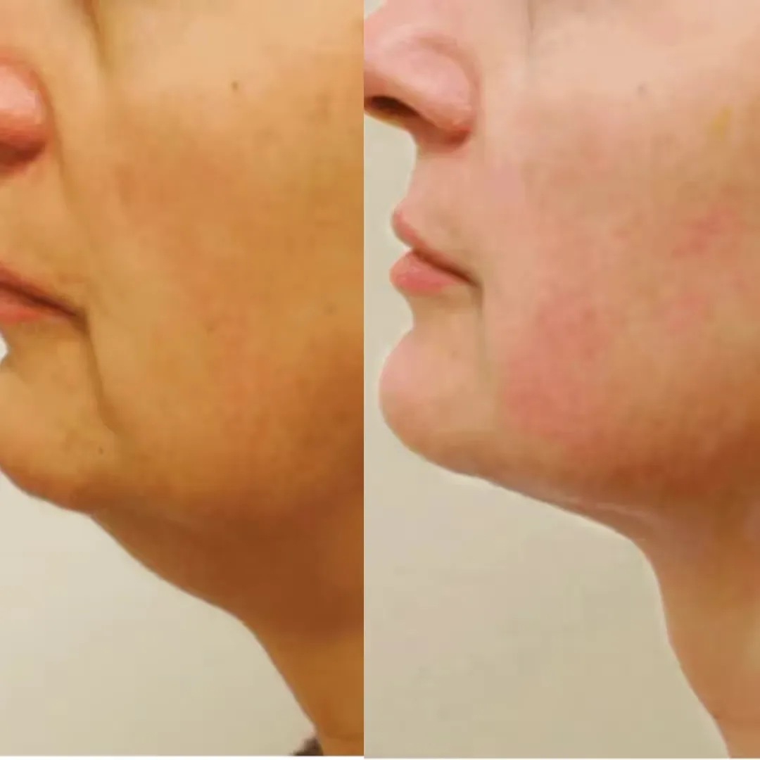Before and after results image from HIFU treatment