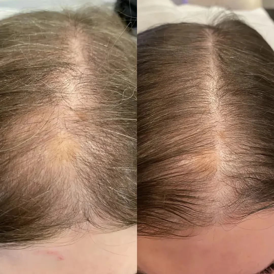 Hydrafacial Keravive treatment before and after results