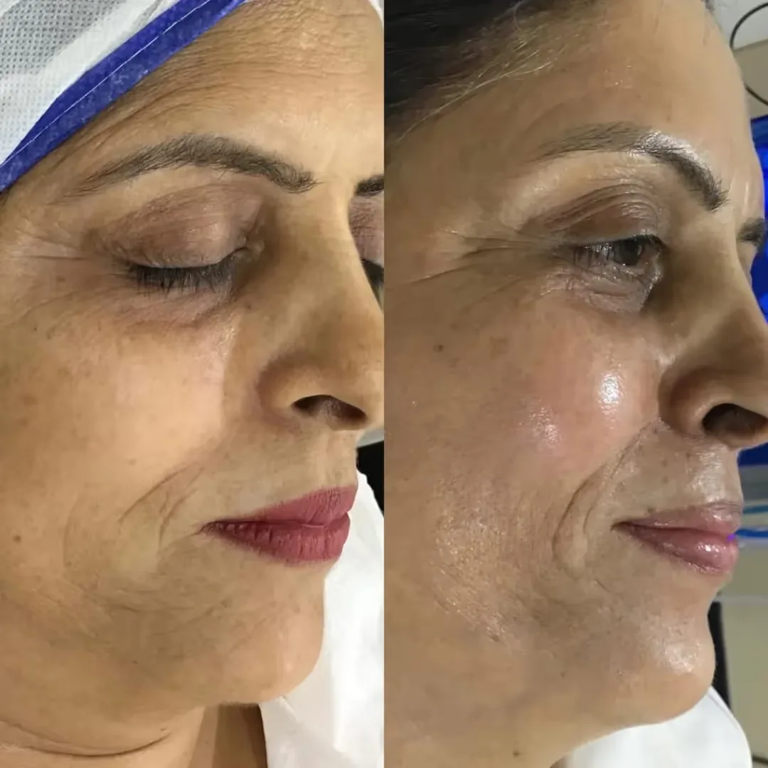 Hydrafacial treatment before and after results on women's face