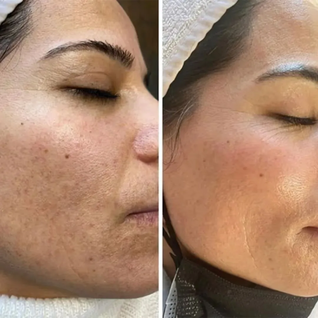 Before and after Glow Drips therapy results