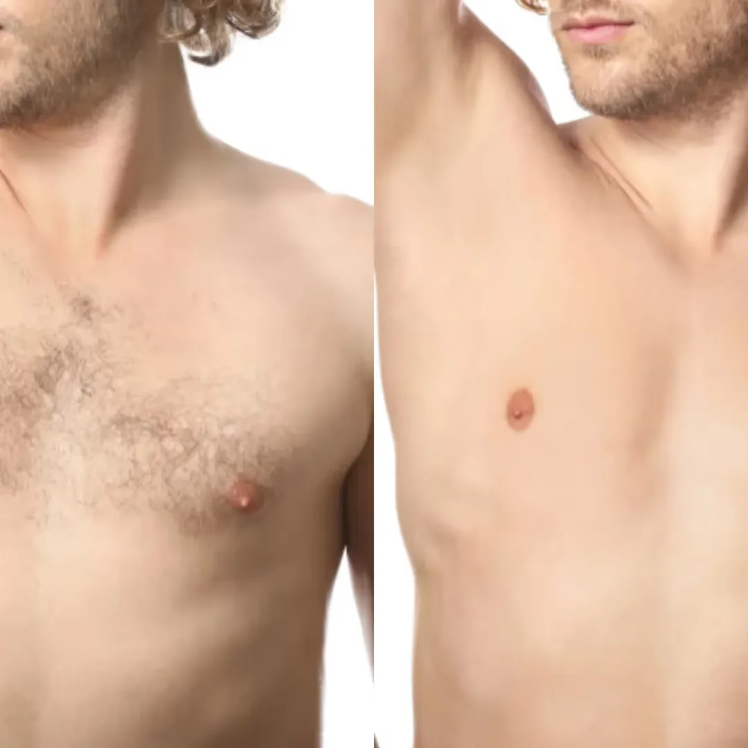 Before and after upper body laser hair removal treatment result