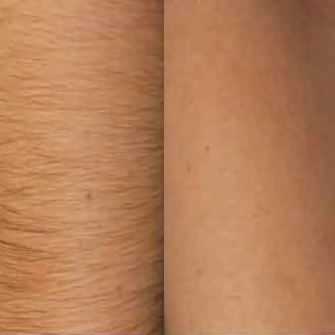 Before and after Laser Hair Removal for Arms treatment