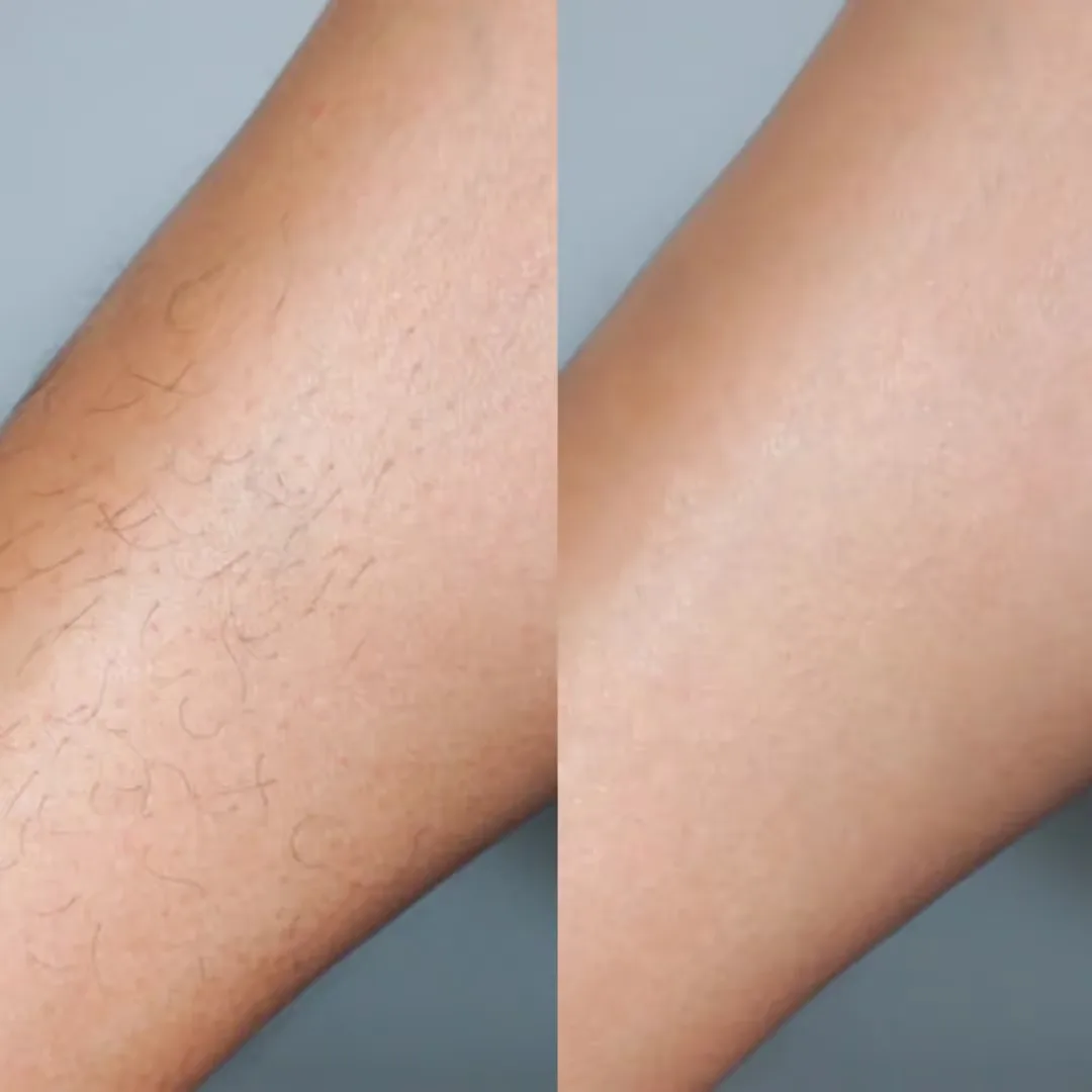Before and After Laser Hair Removal at Home results