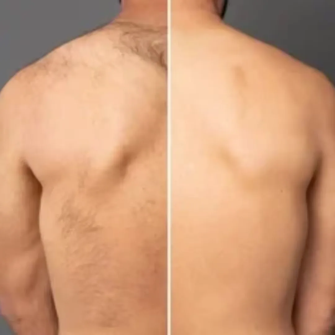 Before and after Laser hair removal of back area images
