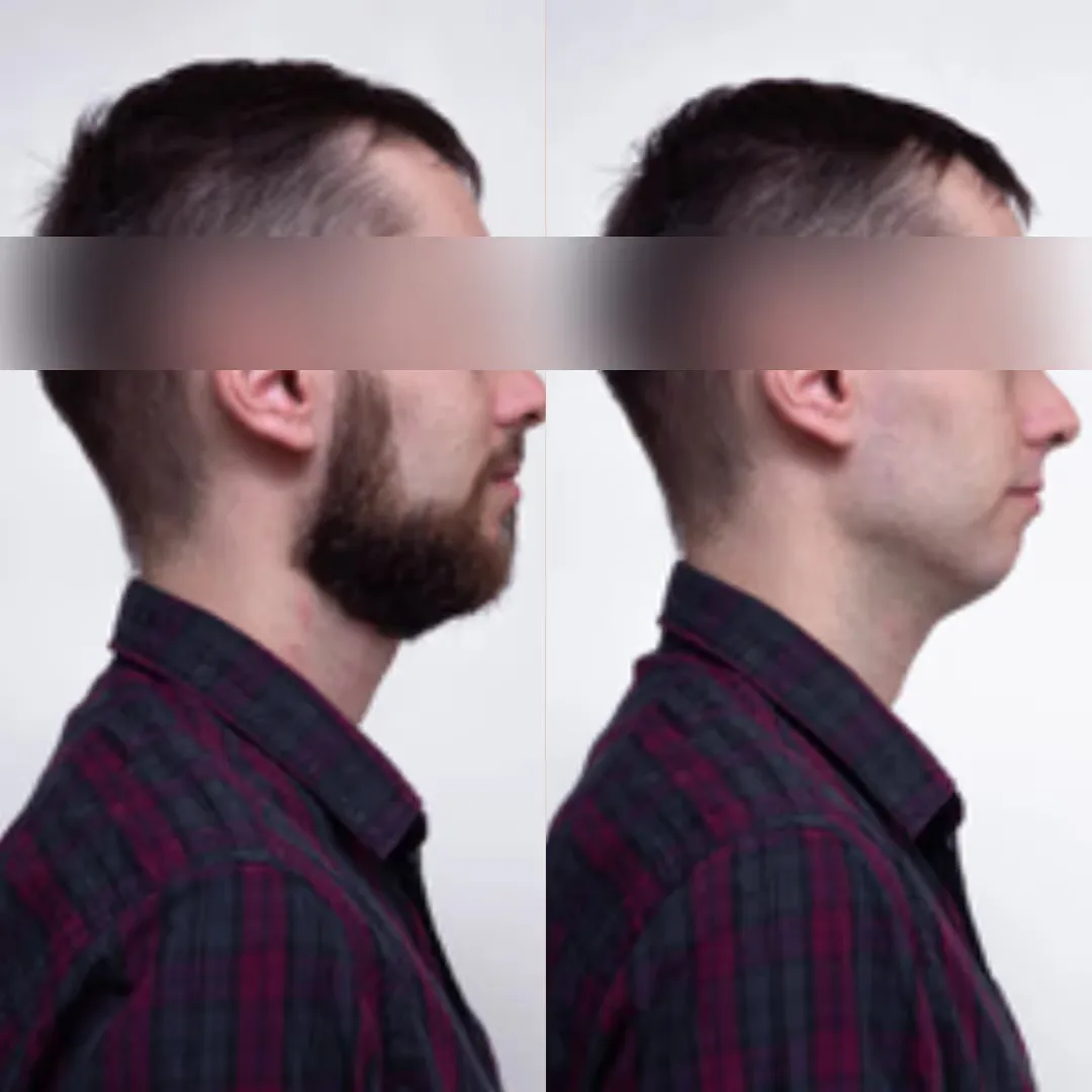 Men's Laser Hair Removal for Face Results