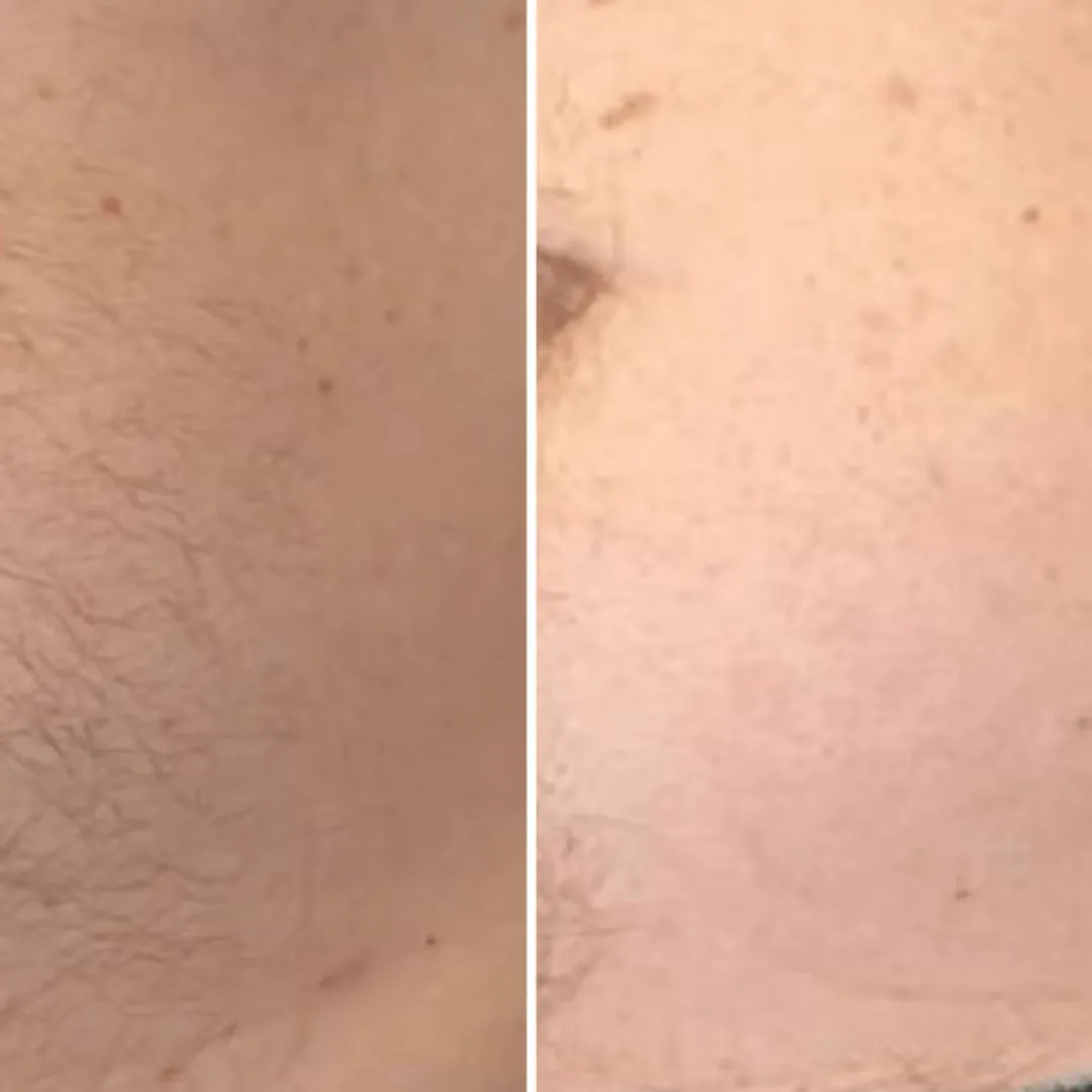Before and after Laser hair removal for stomach result