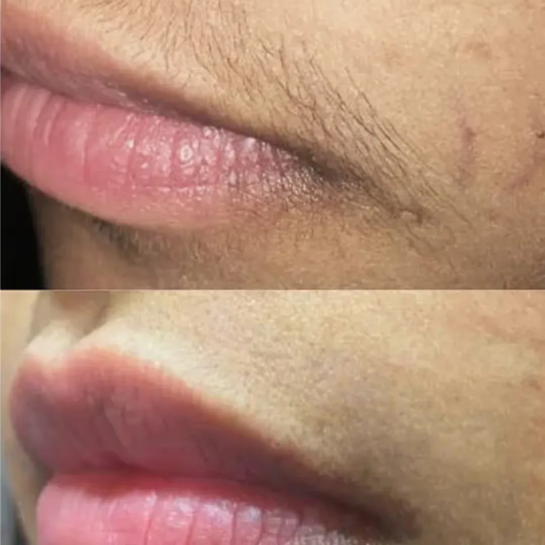 Before and after upper lips laser hair removal result