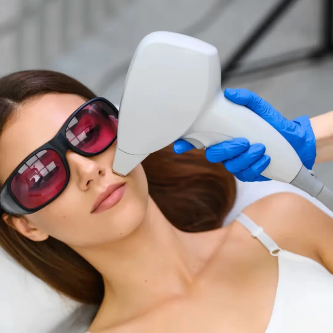 Upper lips laser hair removal treatment is done